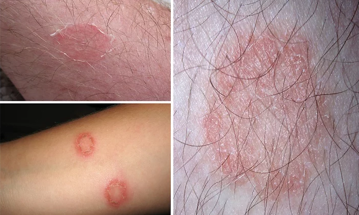 dấu hiệu bệnh hắc lào