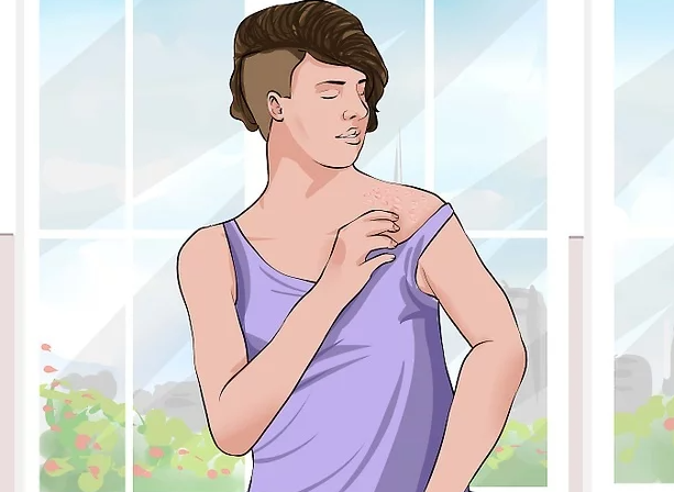 Cách điều trị hắc lào hiệu quả ngay tại nhà