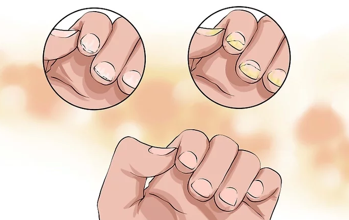 Cách điều trị hắc lào hiệu quả ngay tại nhà