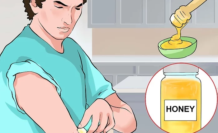 Cách điều trị hắc lào hiệu quả ngay tại nhà