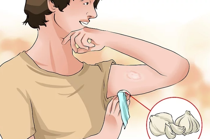 Cách điều trị hắc lào hiệu quả ngay tại nhà