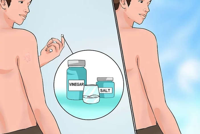 Cách điều trị hắc lào hiệu quả ngay tại nhà